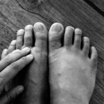 Diabetesfötter: orsak, symtom & behandling